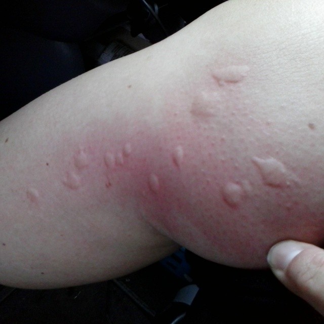 Top 92 Images Flea Bites On Arms Pictures Sharp